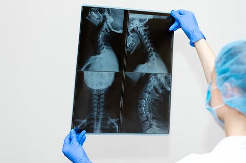 Enfermidade vertebral da osteocondrose