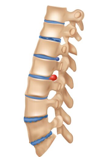 Como é a osteocondrose de Deophrming