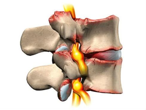 lesións da columna vertebral por osteocondrose